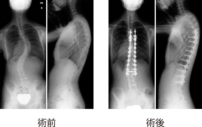 脊椎・脊髄グループ | 岩手医科大学 医学部 整形外科学講座